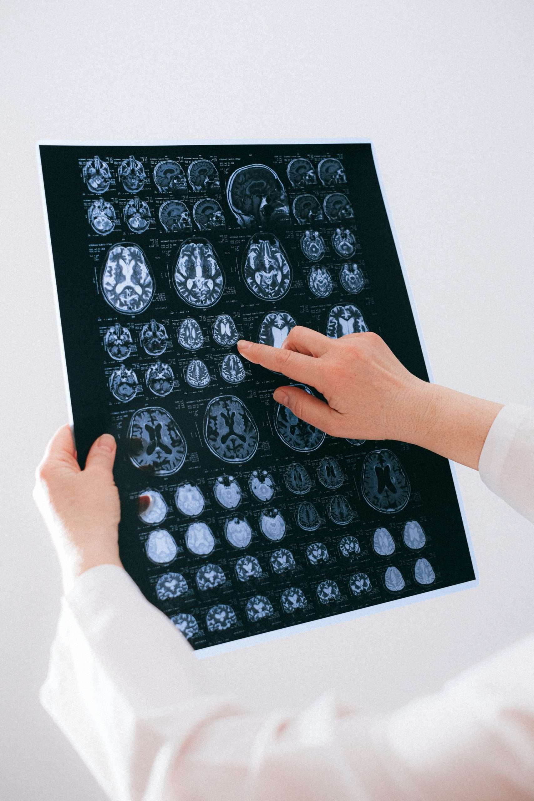 image of brain scan to show cognitive impairment after multiple alcohol rehab detoxifications