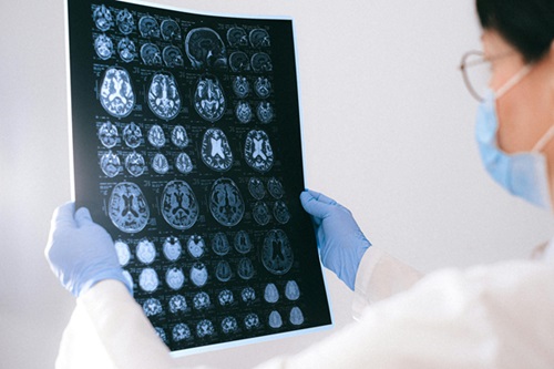 image of doctor looking at brain scan images to answer the question does alcohol protect against alzheimer's disease